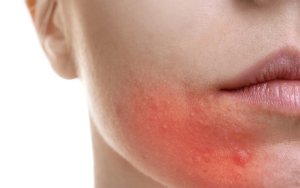 facial-rash