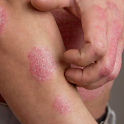 🔬 Demystifying Psoriasis: A Look at Its Challenges and Solutions 🦠